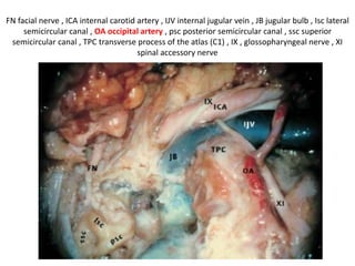 At higher magnified view, note the amount of the bone removed in ITFA with transcondylar transtubercular
approach. , CF carotid foramen , FM foramen magnum , HC hypoglossal canal , JF jugular foramen , MT
mastoid tip , OC occipital condyle , SMF stylomastoid foramen
 
