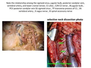 The jugular process and the portion of the occipital condyle have been drilled out. The left
occipital condyle is identified below the jugular bulb and posterior to the internal jugular
vein. * occipital condyle , ICA internal carotid artery , IJV internal jugular vein , JB jugular bulb ,
LSC lateral semicircular canal , P promontory , SS sigmoid sinus
 