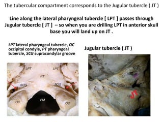 The tubercular compartment corresponds to the Jugular tubercle ( JT )
Line along the lateral pharyngeal tubercle [ LPT ] passes through
Jugular tubercle [ JT ] – so when you are drilling LPT in anterior skull
base you will land up on JT .
LPT lateral pharyngeal tubercle, OC
occipital condyle, PT pharyngeal
tubercle, SCG supracondylar groove
Jugular tubercle ( JT )
 