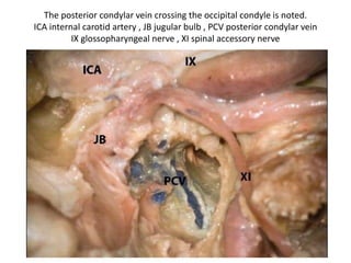 Lower clivus + petrous bone [ base ]
Petrous
bone
devided
into three
1/3rds
 
