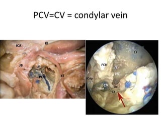 Lower clivus + petrous bone [ base ] + Zygomatic bone
Petrous bone devided
into three 1/3rds
 
