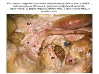 11th nerve bisects the upper end of IJC whereas vertical part of 7th nerve bisects the jugular bulb .
The lateral aspect of the jugular bulb, sigmoid sinus, and internal jugular vein has been removed. On the
medial wall of the jugular bulb the inferior petrosal sinus is identified. The opening of the posterior
condylar vein is seen. * occipital condyle , ICA internal carotid artery , JB jugular bulb , P promontory ,
SS sigmoid sinus
 