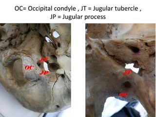 * occipital condyle , IJV internal jugular vein , IPS inferior petrosal sinus
, JB jugular vein , PCV posterior condylar vein , SS sigmoid sinus
 