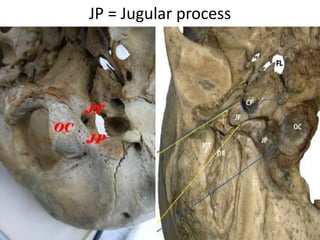 The glossopharyngeal nerve has its
own dural porus, which is situated
0-3 mm upwards from the dural
porus of the tenth cranial nerve. The
vagus and the accessory nerve exit
the posterior fossa together in a
sleeve of dura through the jugular
foramen.
 