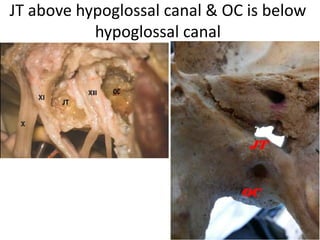 The glossopharyngeal and vagus nerves are well
identified in the cerebellomedullary cistern before
entering the jugular foramen.
 
