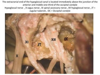 11th nerve hitches over the transverse process of atlas . -----
Note the relationship among the sigmoid sinus, jugular bulb, posterior condylar vein, vertebral
artery, and lower cranial nerves. C1 atlas , C2N C2 nerve , JB jugular bulb , PCV posterior
condylar vein SS sigmoid sinus , TP transverse process of C1 , VA vertebral artery , X vagus nerve
, XI spinal accessory nerve
 