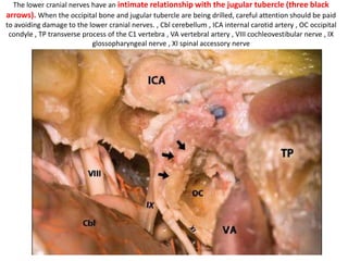 Note the relationship among the sigmoid sinus, jugular bulb, posterior condylar vein,
vertebral artery, and lower cranial nerves. C1 atlas , C2N C2 nerve , JB jugular bulb ,
PCV posterior condylar vein SS sigmoid sinus , TP transverse process of C1 , VA
vertebral artery , X vagus nerve , XI spinal accessory nerve
selective neck dissection photo
 