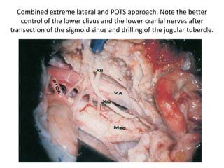 The posterior condylar vein crossing the occipital condyle is noted.
ICA internal carotid artery , JB jugular bulb , PCV posterior condylar vein
IX glossopharyngeal nerve , XI spinal accessory nerve
 