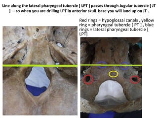 Line along the lateral pharyngeal tubercle [ LPT ] passes through Jugular tubercle [ JT
] – so when you are drilling LPT in anterior skull base you will land up on JT .
Red rings = hypoglossal canals , yellow
ring = pharyngeal tubercle [ PT ] , blue
rings = lateral pharyngeal tubercle [
LPT]
 