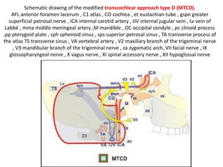 After removal of the posterior condylar vein and further removal of the occipital condyle (OC),
the hypoglossal nerve (XII) is noted. , ICA internal carotid artery , JB jugular bulb
JT jugular tubercle , OC occipital condyle , VA vertebral artery , XI spinal accessory nerve , XII
hypoglossal nerve
 