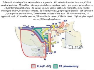 JT above hypoglossal canal & OC is below
hypoglossal canal
 