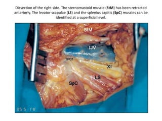 The extracranial end of the hypoglossal canal is located immediately above the junction of the
anterior and middle one-third of the occipital condyle
Hypoglossal nerve , X vagus nerve , XI spinal accessory nerve , XII hypoglossal nerve , JT =
Jugular tubercle , OC = Occipital condyle
 