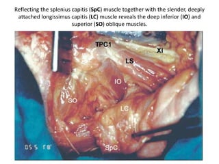 The lower cranial nerves have an intimate relationship with the jugular tubercle (three black
arrows). When the occipital bone and jugular tubercle are being drilled, careful attention should be paid
to avoiding damage to the lower cranial nerves. , Cbl cerebellum , ICA internal carotid artery , OC occipital
condyle , TP transverse process of the C1 vertebra , VA vertebral artery , VIII cochleovestibular nerve , IX
glossopharyngeal nerve , XI spinal accessory nerve
 