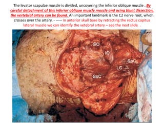 Combined extreme lateral and POTS approach. Note the better
control of the lower clivus and the lower cranial nerves after
transection of the sigmoid sinus and drilling of the jugular tubercle.
 