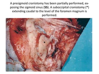 From Laterally
3. Modified trans-cochlear approach type D (MTCD)
 