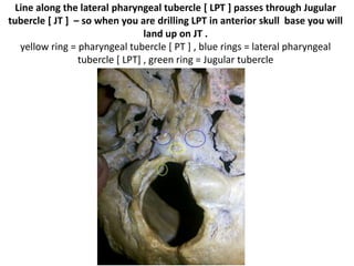 Line along the lateral pharyngeal tubercle [ LPT ] passes through Jugular
tubercle [ JT ] – so when you are drilling LPT in anterior skull base you will
land up on JT .
yellow ring = pharyngeal tubercle [ PT ] , blue rings = lateral pharyngeal
tubercle [ LPT] , green ring = Jugular tubercle
 