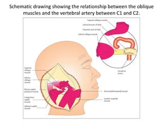 Anatomical dissection showing a transcochlear approach type D with jugular bulb in place.
C2N C2 nerve , FN facial nerve , lCA internal carotid artery , IJV internal jugular vein , JB jugular bulb , SS
sigmoid sinus , VA vertebral artery , V trigeminal nerve
 