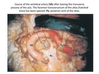 Schematic drawing of the extreme lateral approach. , AFL anterior foramen lacerum , C1 first
cervical vertebra , CO cochlea , et eustachian tube , ev emissary vein , gps greater petrosal nerve
, ICA internal carotid artery , JV jugular vein , Lv vein of Labbé , M mandible , mma middle
meningeal artery , oc occipital condyle , pc clinoid process , pp pterygoid process , sph sphenoid
, sps superior petrosal sinus , TA transverse process of the atlas , TS transverse sinus , za
zygomatic arch , V2 maxillary nerve , V3 mandibular nerve , VII facial nerve , IX glossopharyngeal
nerve , XII hypoglossal nerve
 