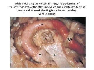 Drawing of the muscles related to the vertebral artery at the suboccipital
region. Reflection of the sternomastoid and the splenius capitis muscles
reveals the deeper muscles in this area.
 
