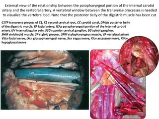 Reflecting the splenius capitis (SpC) muscle together with the slender, deeply
attached longissimus capitis (LC) muscle reveals the deep inferior (IO) and
superior (SO) oblique muscles.
 