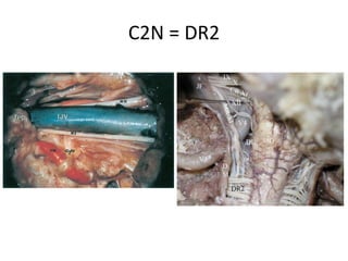 The levator scapulae muscle is divided, uncovering the inferior oblique muscle . By
careful detachment of this inferior oblique muscle muscle and using blunt dissection,
the vertebral artery can be found. An important landmark is the C2 nerve root, which
crosses over the artery. - ----- in anterior skull base by retracting the rectus capitus
lateral muscle we can identify the vetebral artery – see the next slide .
 