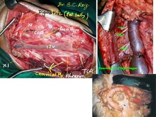 A presigmoid craniotomy has been partially performed, ex-
posing the sigmoid sinus (SS). A suboccipital craniotomy (*)
extending caudal to the level of the foramen magnum is
performed.
 