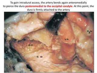 Schematic drawing showing the relationship between the oblique
muscles and the vertebral artery between C1 and C2.
 