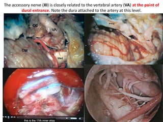 Course of the vertebral artery (VA) after leaving the transverse
process of the axis. The foramen transversarium of the atlas (hatched
lines) has been opened. Pa, posterior arch of the atlas.
 