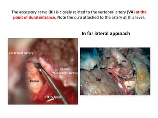While mobilizing the vertebral artery, the periosteum of
the posterior arch of the atlas is elevated and used to pro-tect the
artery and to avoid bleeding from the surrounding
venous plexus
 