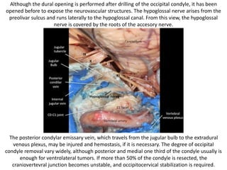 C2 nerve root below the 11th nerve
in posterior triangle clearance in SLD
the C2 nerve root is seen crossing
the vertebral artery (VA).
 