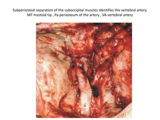 External view of the relationship between the parapharyngeal portion of the internal carotid
artery and the vertebral artery. A vertebral window between the transverse processes is needed
to visualize the vertebral bed. Note that the posterior belly of the digastric muscle has been cut
C1TP transverse process of C1, C2 second cervical root, CC carotid canal, DMpb posterior belly
of the digastric muscle, FA facial artery, ICAp parapharyngeal portion of the internal carotid
artery, IJV internal jugular vein, SCG superior cervical ganglion, SG spinal ganglion,
SHM stylohyoid muscle, SP styloid process, SPM stylopharyngeus muscle, VA vertebral artery,
VIIcn facial nerve, IXcn glossopharyngeal nerve, Xcn vagus nerve, XIcn accessory nerve, XIIcn
hypoglossal nerve
 