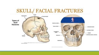 SKULL/ FACIAL FRACTURES
 