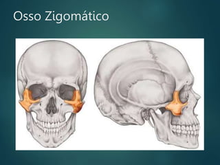 Osso Zigomático
 