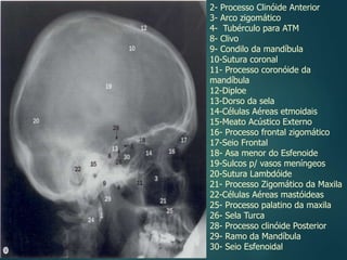 2- Processo Clinóide Anterior
3- Arco zigomático
4- Tubérculo para ATM
8- Clivo
9- Condilo da mandíbula
10-Sutura coronal
11- Processo coronóide da
mandíbula
12-Diploe
13-Dorso da sela
14-Células Aéreas etmoidais
15-Meato Acústico Externo
16- Processo frontal zigomático
17-Seio Frontal
18- Asa menor do Esfenoide
19-Sulcos p/ vasos meníngeos
20-Sutura Lambdóide
21- Processo Zigomático da Maxila
22-Células Aéreas mastóideas
25- Processo palatino da maxila
26- Sela Turca
28- Processo clinóide Posterior
29- Ramo da Mandíbula
30- Seio Esfenoidal
 