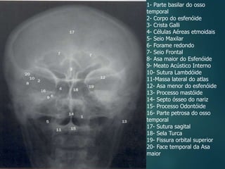 1- Parte basilar do osso
temporal
2- Corpo do esfenóide
3- Crista Galli
4- Células Aéreas etmoidais
5- Seio Maxilar
6- Forame redondo
7- Seio Frontal
8- Asa maior do Esfenóide
9- Meato Acústico Interno
10- Sutura Lambdóide
11-Massa lateral do atlas
12- Asa menor do esfenóide
13- Processo mastóide
14- Septo ósseo do nariz
15- Processo Odontóide
16- Parte petrosa do osso
temporal
17- Sutura sagital
18- Sela Turca
19- Fissura orbital superior
20- Face temporal da Asa
maior
 