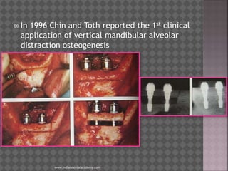  In 1996 Chin and Toth reported the 1st clinical
application of vertical mandibular alveolar
distraction osteogenesis
www.indiandentalacademy.com
 