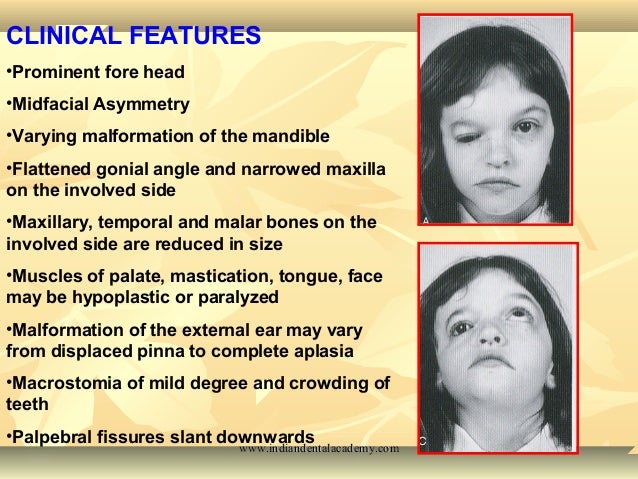 Craniofacial Syndromes
