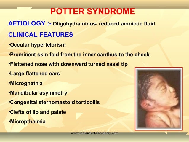 Craniofacial syndromes