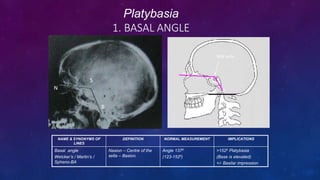 Platybasia Angle platybasia-angle