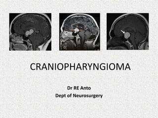 CRANIOPHARYNGIOMA
Dr RE Anto
Dept of Neurosurgery
 