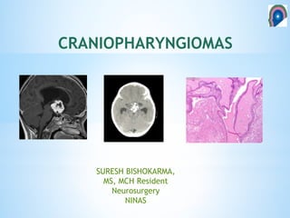 CRANIOPHARYNGIOMAS
SURESH BISHOKARMA,
MS, MCH Resident
Neurosurgery
NINAS
 