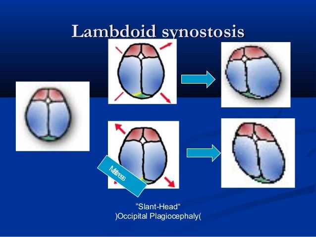 Craniostenosis