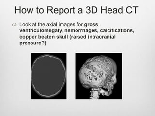 How to Report a 3D Head CT
 Look at the axial images for gross
ventriculomegaly, hemorrhages, calcifications,
copper beaten skull (raised intracranial
pressure?)
 