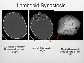 Lambdoid Synostosis
Controlateral Posterior
Bossing and trapezoid
shape
Absent Suture on the
Right
Mastoid Bump and
absent suture on the
right
 
