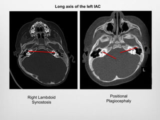 L
Long axis of the left IAC
Positional
Plagiocephaly
Right Lambdoid
Synostosis
 