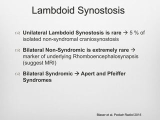 Lambdoid Synostosis
 Unilateral Lambdoid Synostosis is rare  5 % of
isolated non-syndromal craniosynostosis
 Bilateral Non-Syndromic is extremely rare 
marker of underlying Rhomboencephalosynapsis
(suggest MRI)
 Bilateral Syndromic  Apert and Pfeiffer
Syndromes
Blaser et al. Pediatr Radiol 2015
 
