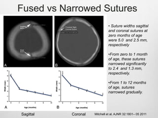 Fused vs Narrowed Sutures
Sagittal Coronal Mitchell et al. AJNR 32:1801– 05 2011
• Suture widths sagittal
and coronal sutures at
zero months of age
were 5.0 and 2.5 mm,
respectively
•From zero to 1 month
of age, these sutures
narrowed significantly
to 2.4 and 1.3 mm,
respectively.
•From 1 to 12 months
of age, sutures
narrowed gradually.
 