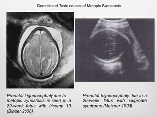 Prenatal trigonocephaly due to
metopic synostosis is seen in a
29-week fetus with trisomy 13
(Blaser 2008)
Prenatal trigonocephaly due in a
26-week fetus with valproate
syndrome (Meizner 1993)
Genetic and Toxic causes of Metopic Synostosis
 