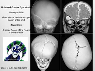Blaser et al. Pediatr Radiol 2008
Unilateral Coronal Synostosis
-Harlequin Orbit
-Retrusion of the lateral/upper
margin of the orbit
-Nasal tilting
-Crooked Aspect of the Normal
Coronal Suture
by Khamykc-Blackout
 