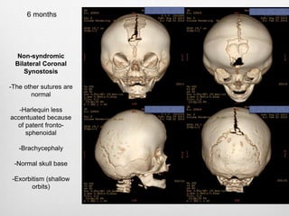 Non-syndromic
Bilateral Coronal
Synostosis
-The other sutures are
normal
-Harlequin less
accentuated because
of patent fronto-
sphenoidal
-Brachycephaly
-Normal skull base
-Exorbitism (shallow
orbits)
6 months
 